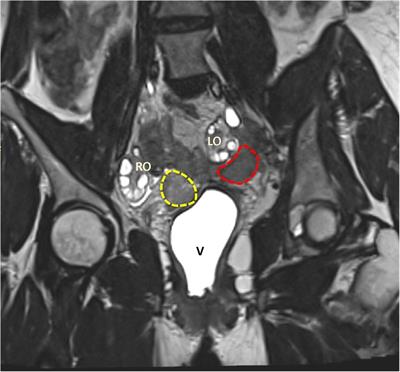 Feasibility and safety of combined laparoscopic and transvaginal oocyte retrieval in a woman with vaginal recurrence of cervical adenocarcinoma: a case report